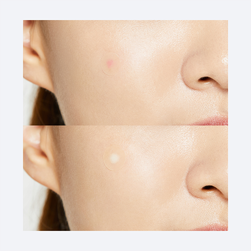 Acne Pimple Master 24 patches