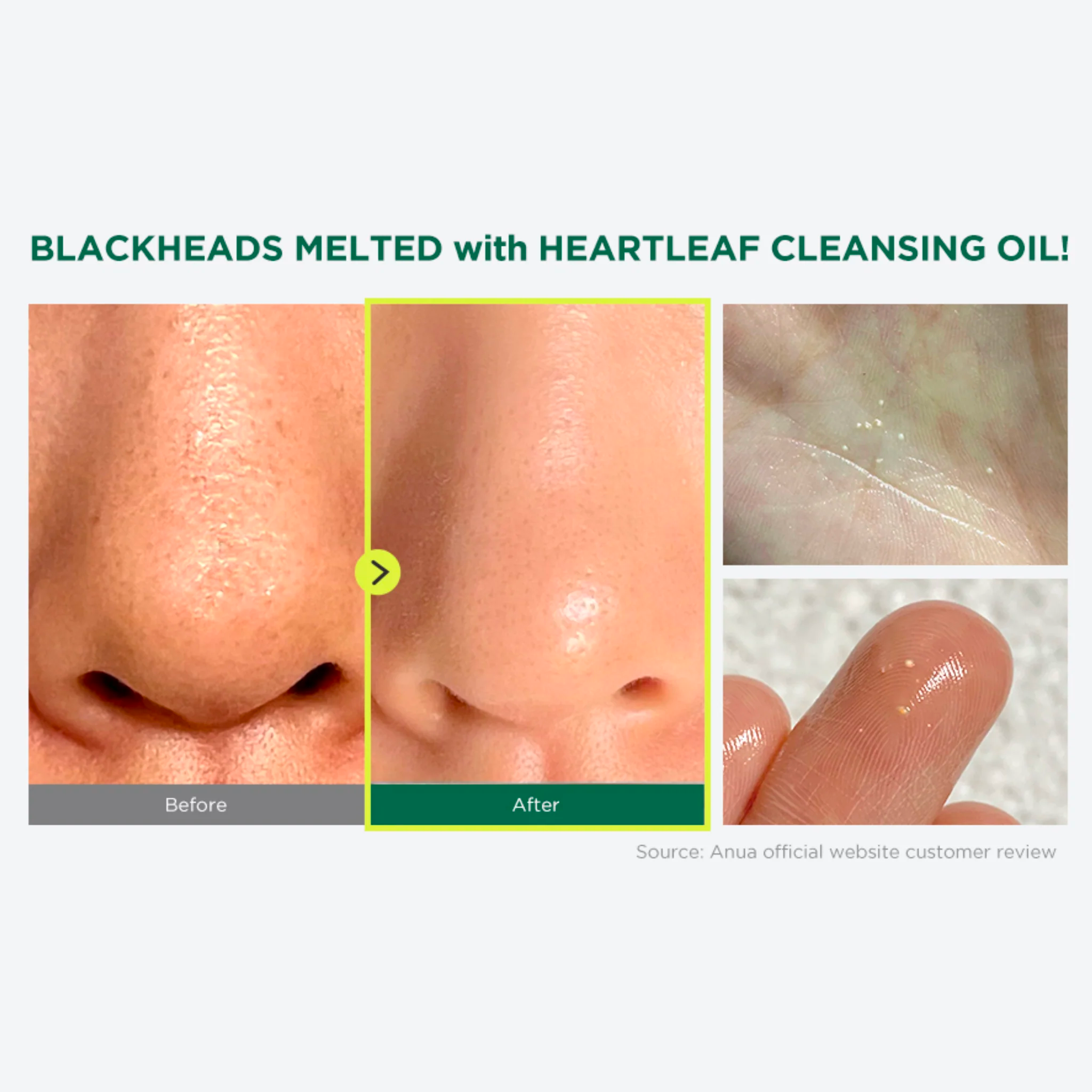 Blackheads melted with Heartleaf Cleansing Oil before and after